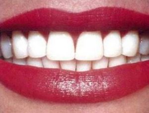 Teeth_Whitening_Adelaide